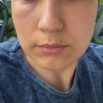 Bioderma Ürünleri Cildime Alerji Yaptı