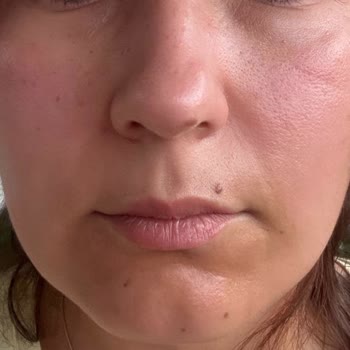 Bioderma Ürünleri Cildime Alerji Yaptı