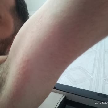 Tereson Alerjik Yarandı Kolum Şişti!