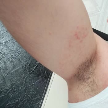 Tereson Alerjik Yarandı Kolum Şişti!