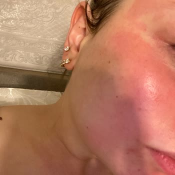 Neutrogena Felaket Yüzüm Yanıyor