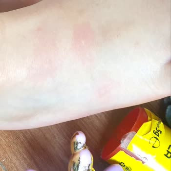 Mustela Very High Protection Sun SPF50+ Çocuklar İçin Alerji Yaptı!
