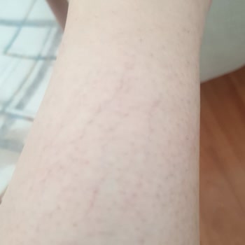 Mustela Very High Protection Sun SPF50+ Çocuklar İçin Alerji Yaptı!