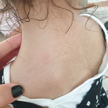 Mustela Very High Protection Sun SPF50+ Çocuklar İçin Alerji Yaptı!