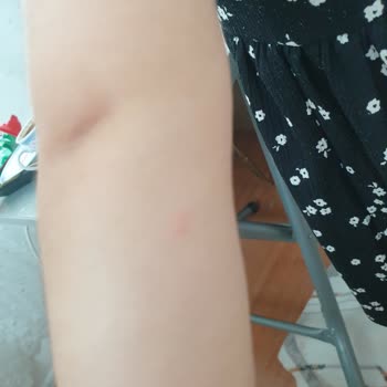 Mustela Very High Protection Sun SPF50+ Çocuklar İçin Alerji Yaptı!