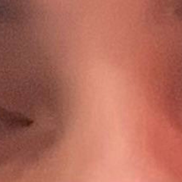 Maya Estetik'te Botoks Pişmanlığı