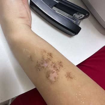 As Estetik (İstanbul) Kartal Şubesi Yanık İzi