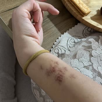 As Estetik (İstanbul) Kartal Şubesi Yanık İzi