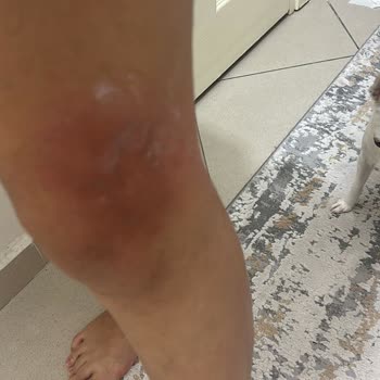 As Estetik (İstanbul) Kartal Şubesi Yanık İzi