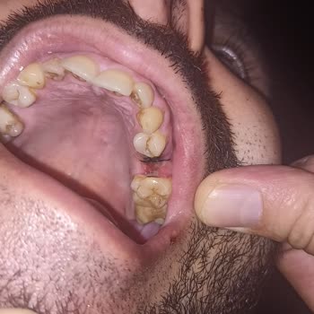 Mesam Ağız ve Diş Sağlığı Polikliniği Mesam Diş Polikliniği Yanlış Diş Çekimi