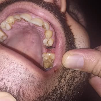 Mesam Ağız ve Diş Sağlığı Polikliniği Mesam Diş Polikliniği Yanlış Diş Çekimi