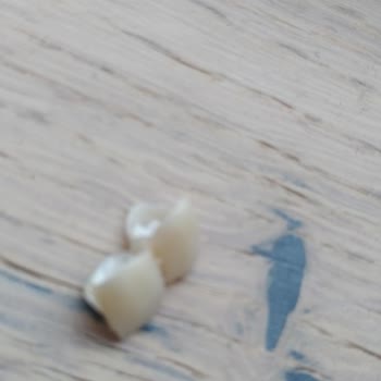 Beyaz Işık Ağız Ve Diş Sağlığı Kaplamam Düştü Mağdur Oldum!