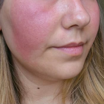 Yves Rocher Ürünler Yüzümü Yaktı.