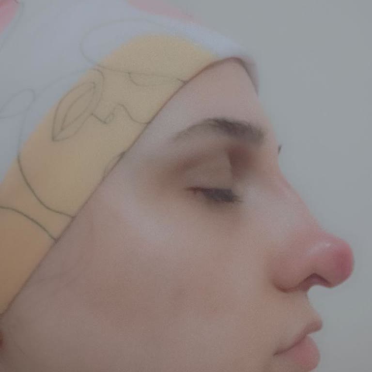 Gülben Sayıner Beauty Burun Dolgusu Göz Kaybına Sebep Oldu