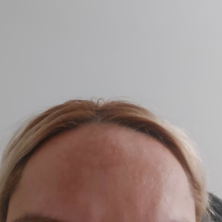 Maya Estetik Leke Tedavisi Basarisiz