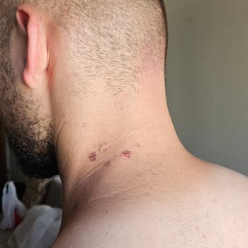 Mona Güzellik & Estetik İşlem Sonrası Vücutta Yanık!