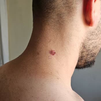 Mona Güzellik & Estetik İşlem Sonrası Vücutta Yanık!