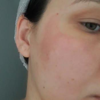 Görkito Peeling Yüzümü Yaktı