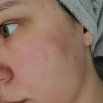 Görkito Peeling Yüzümü Yaktı