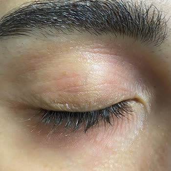 Skinfood Egzama Ve Kızarıklık