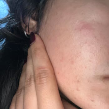 Garnier Güneş Kremi Cildimde Sivilcelenme Yaptı