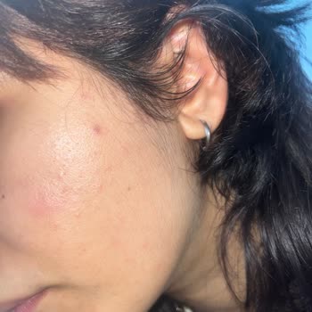 Garnier Güneş Kremi Cildimde Sivilcelenme Yaptı