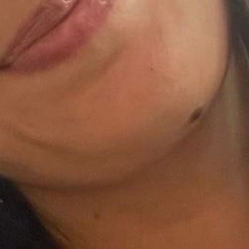 Başakşehir Çam ve Sakura Şehir Hastanesi Yüze Plastik Cerrah Tarafından Atılan Dikiş Hüsranı