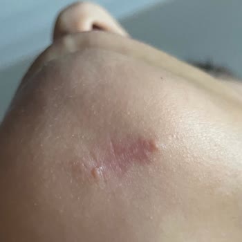 Başakşehir Çam ve Sakura Şehir Hastanesi Yüze Plastik Cerrah Tarafından Atılan Dikiş Hüsranı