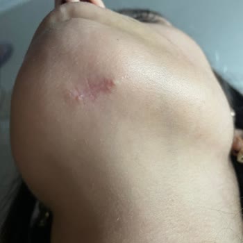 Başakşehir Çam ve Sakura Şehir Hastanesi Yüze Plastik Cerrah Tarafından Atılan Dikiş Hüsranı