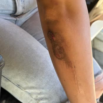 İSKİ Çalışması Sonucu Yolun Hasarı Ve Kazalar