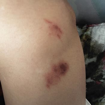 Aris Güzellik Merkezleri Afyon Şubesinde Kolumu Yaktılar!