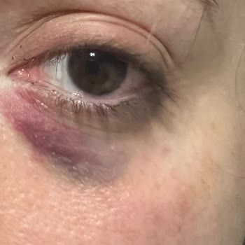 Prof. Dr. Altuğ Çetinkaya Estetik Uygulamalarda Yaşanan Sorunlar