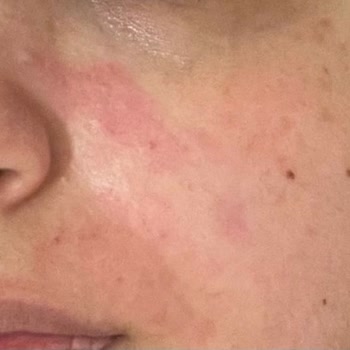 Maruderm Maruz Derm Nemlendirici Cildimi Yaktı!