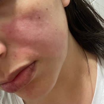 Maruderm Maruz Derm Nemlendirici Cildimi Yaktı!