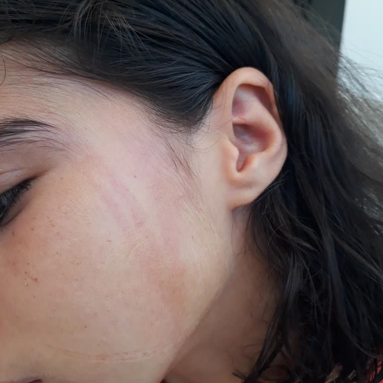 Dalin Sprey Çocuğun Yüzünü Mahvetti