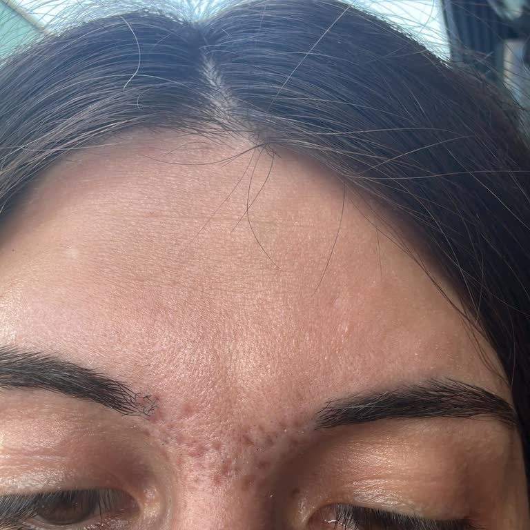 Aris Güzellik Merkezleri İğneli Epilasyon Yanığı