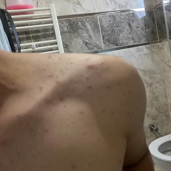 Veet Tüp Dökücü Sonrası Sivilce