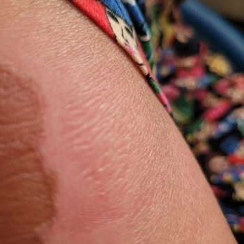 Trendyol'dan Aldığım Güneş Kremi Yanık Yaptı!