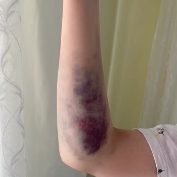 Öztan Hastanesi Uşak'ta Hastane Müdahalesi Sonucu Yaşanan Sağlık Sorunu