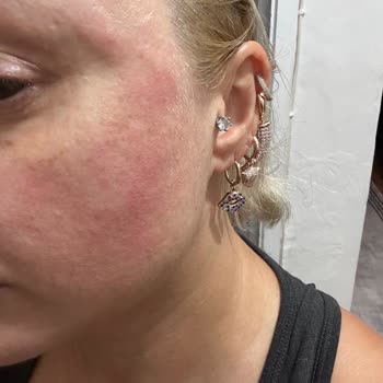 Koreaco Cilt Alerjisi Yapan Ürün Ve Firma Şikayeti