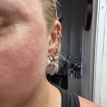 Koreaco Cilt Alerjisi Yapan Ürün Ve Firma Şikayeti