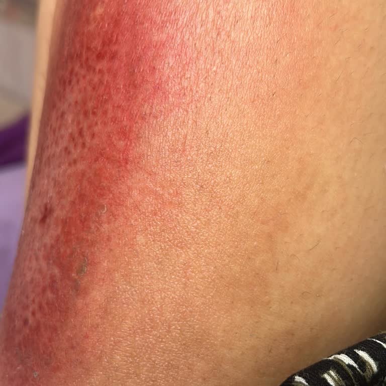 Fatma Özçalışkan Güzellik Merkezi Kimyasal Peeling Yapılarak Yandım