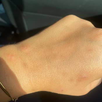 Golf Dondurma Vücutta Alerjisi Yapması