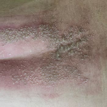 Artçüre Denen Yakı Pişmanlığı