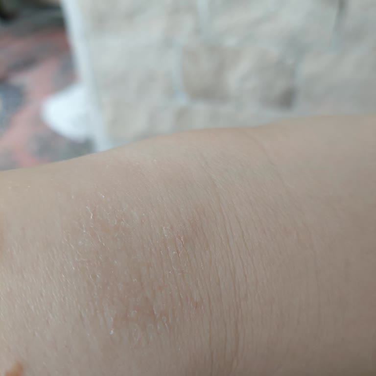 Huawei Watch Bilek Yanması!