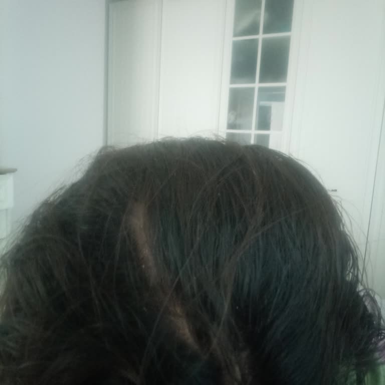 Vichy Dercos Shampoo Does Not Help With Dandruff