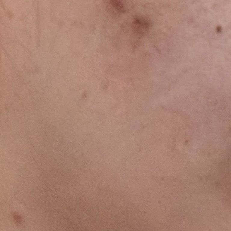 Bioderma AKN Mat Ürünü Akne Yaptı