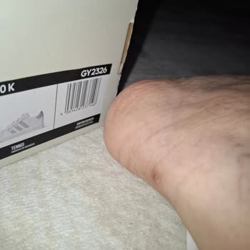 adidas Aldığım Ayakkabının Sadece Tek Ayağının Vurması Çok İlginç