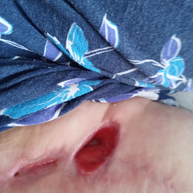 Uludağ Üniversitesi Tıp Fakültesi Hastanesi Acil Müdahale Gerektiren Kanser Tedavisinde Gecikmeler