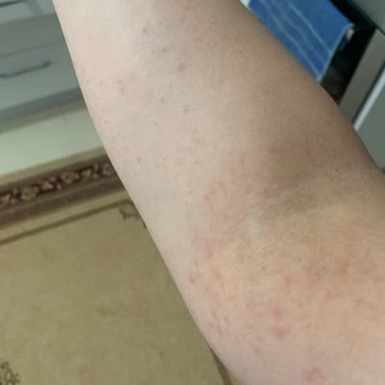 Mustela Güneş Kremi Alerji